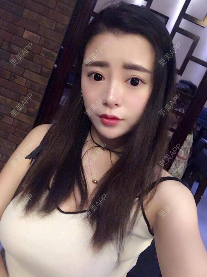 更美 - 初秋繁华落尽的假体隆胸经验 | 丰胸（隆胸） | 假体隆胸 | 南京