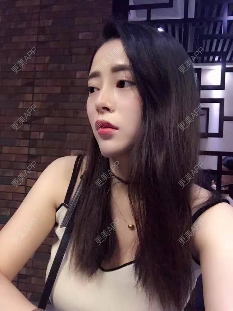 更美 - 初秋繁华落尽的假体隆胸经验 | 丰胸（隆胸） | 假体隆胸 | 南京