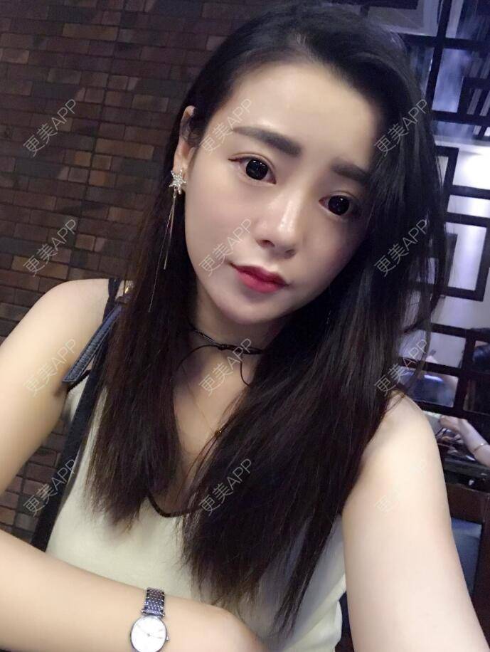 更美 - 初秋繁华落尽的假体隆胸经验 | 丰胸（隆胸） | 假体隆胸 | 南京