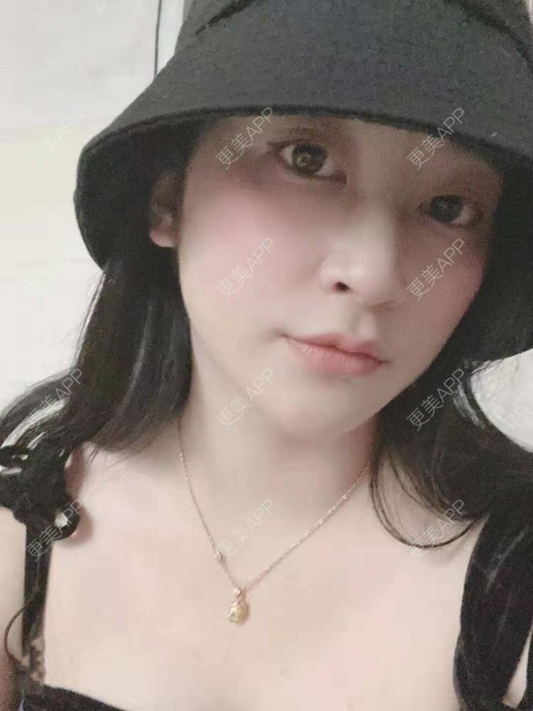 更美 - 更美用户129LF9Yh6a的玻尿酸下巴经验 | 视频日记 | 玻尿酸下巴 | 广州