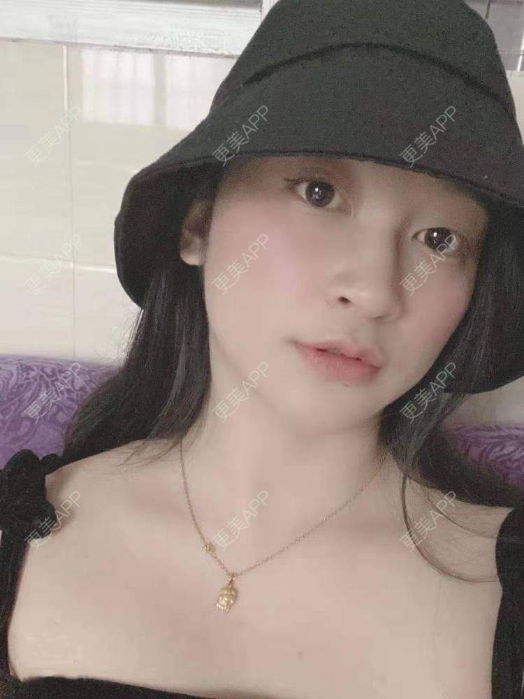 更美 - 更美用户129LF9Yh6a的玻尿酸下巴经验 | 视频日记 | 玻尿酸下巴 | 广州