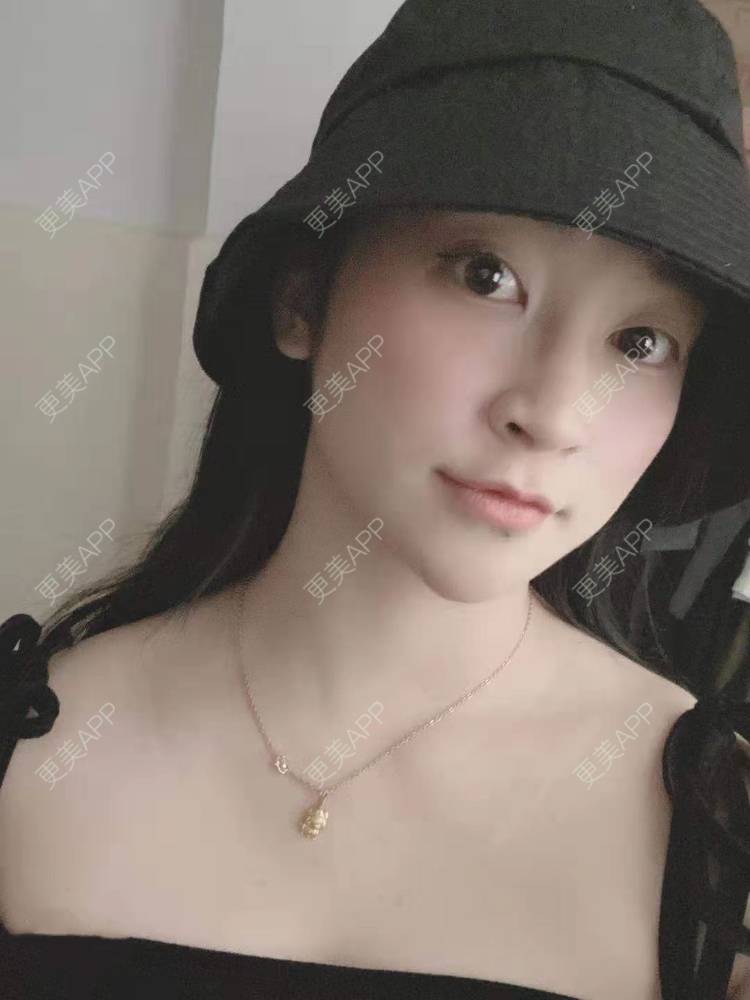 更美 - 更美用户129LF9Yh6a的玻尿酸下巴经验 | 视频日记 | 玻尿酸下巴 | 广州