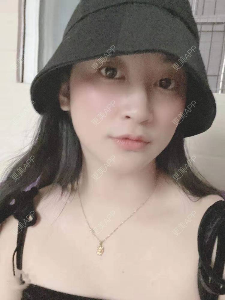 更美 - 更美用户129LF9Yh6a的玻尿酸下巴经验 | 视频日记 | 玻尿酸下巴 | 广州