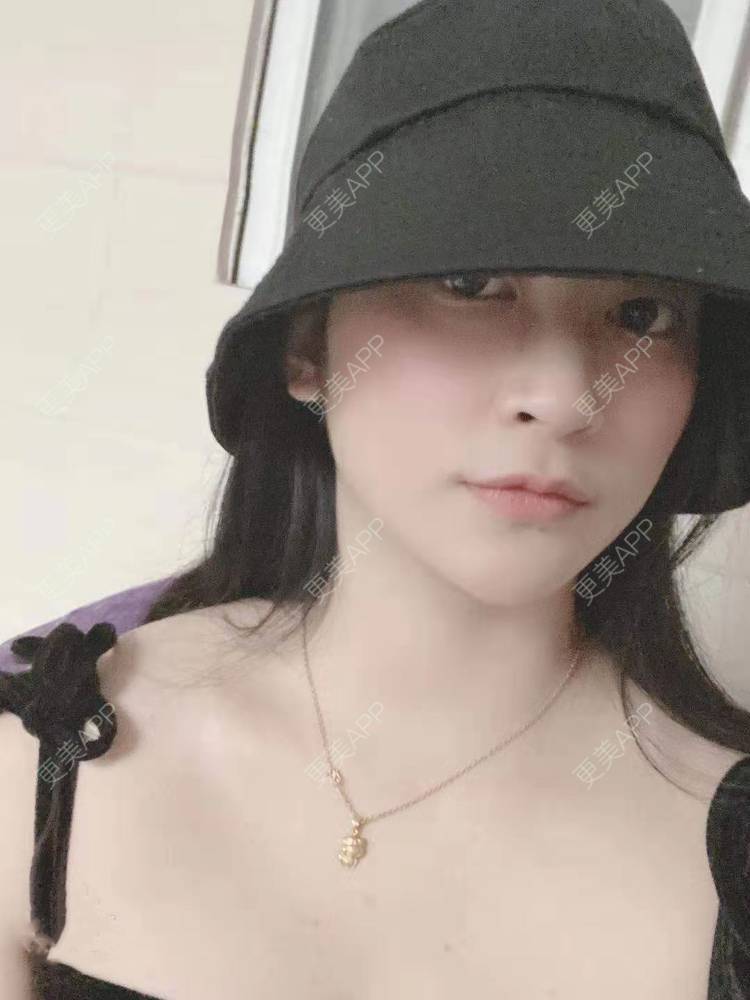 更美 - 更美用户129LF9Yh6a的玻尿酸下巴经验 | 视频日记 | 玻尿酸下巴 | 广州