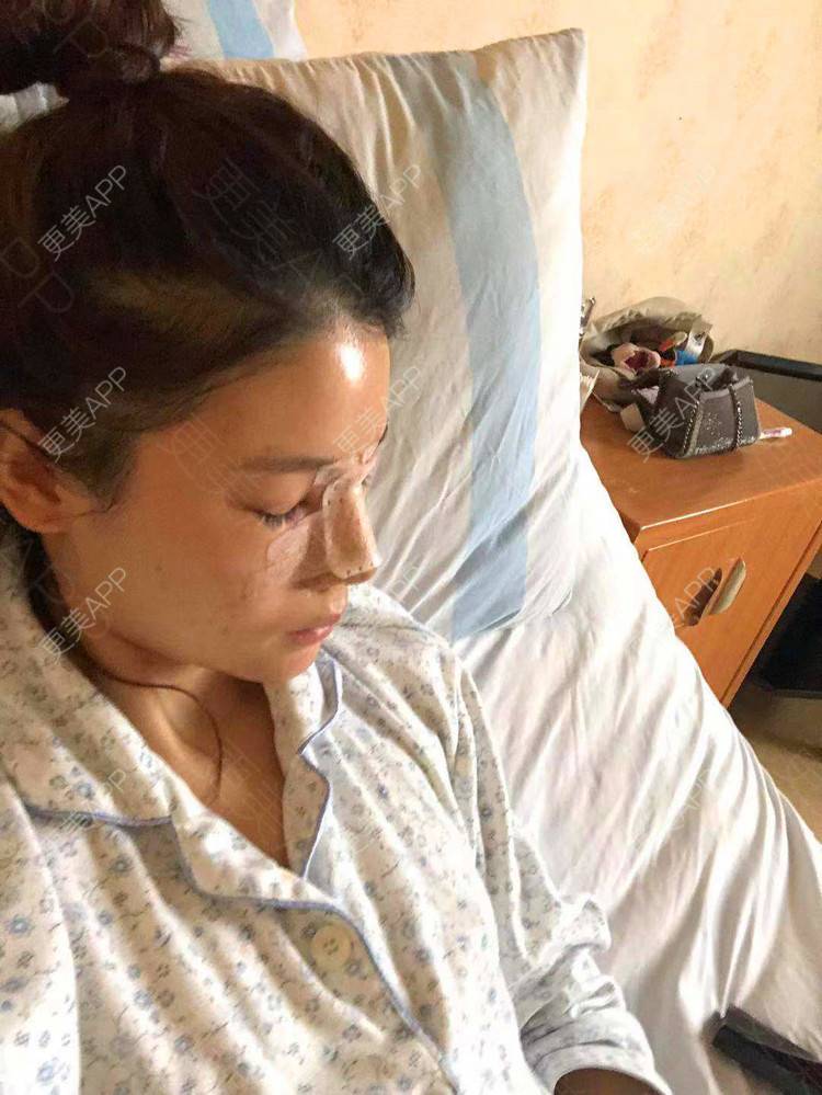 更美 - 雯晓晓的鼻部硅胶假体取出经验 | 鼻部硅胶假体取出