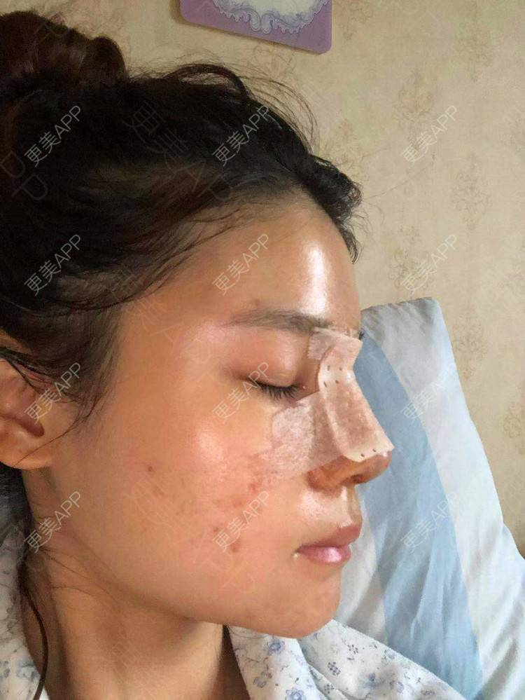 更美 - 雯晓晓的鼻部硅胶假体取出经验 | 鼻部硅胶假体取出