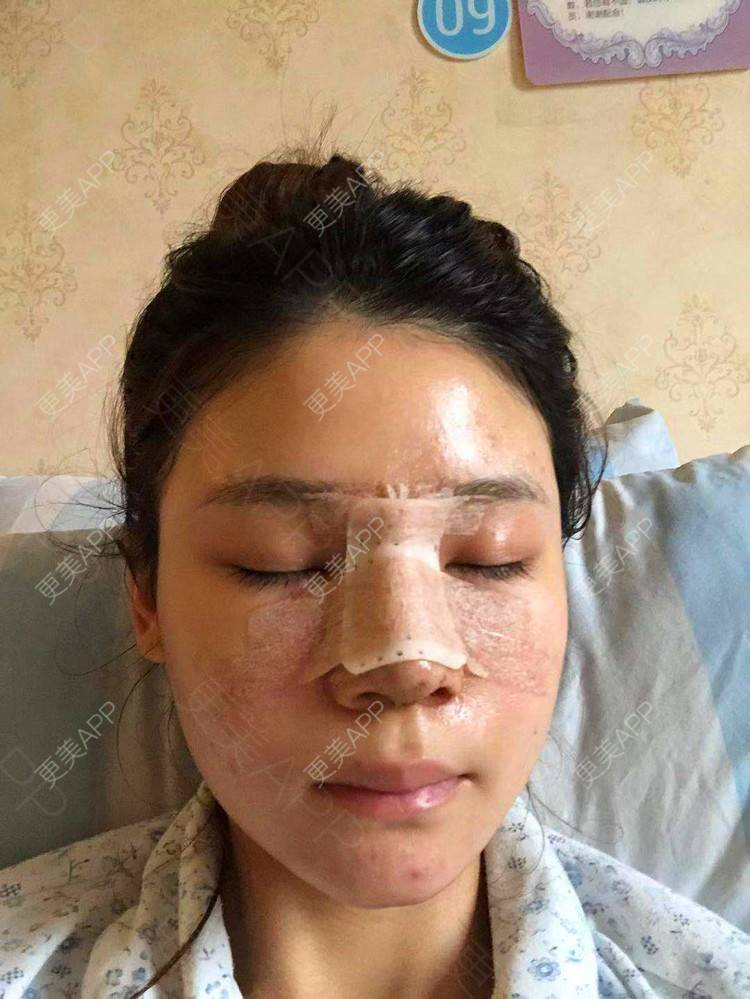 更美 - 雯晓晓的鼻部硅胶假体取出经验 | 鼻部硅胶假体取出