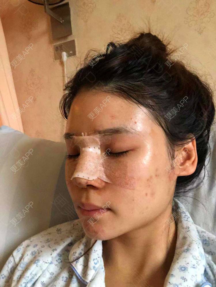 更美 - 雯晓晓的鼻部硅胶假体取出经验 | 鼻部硅胶假体取出