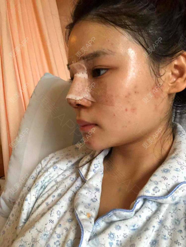 更美 - 雯晓晓的鼻部硅胶假体取出经验 | 鼻部硅胶假体取出