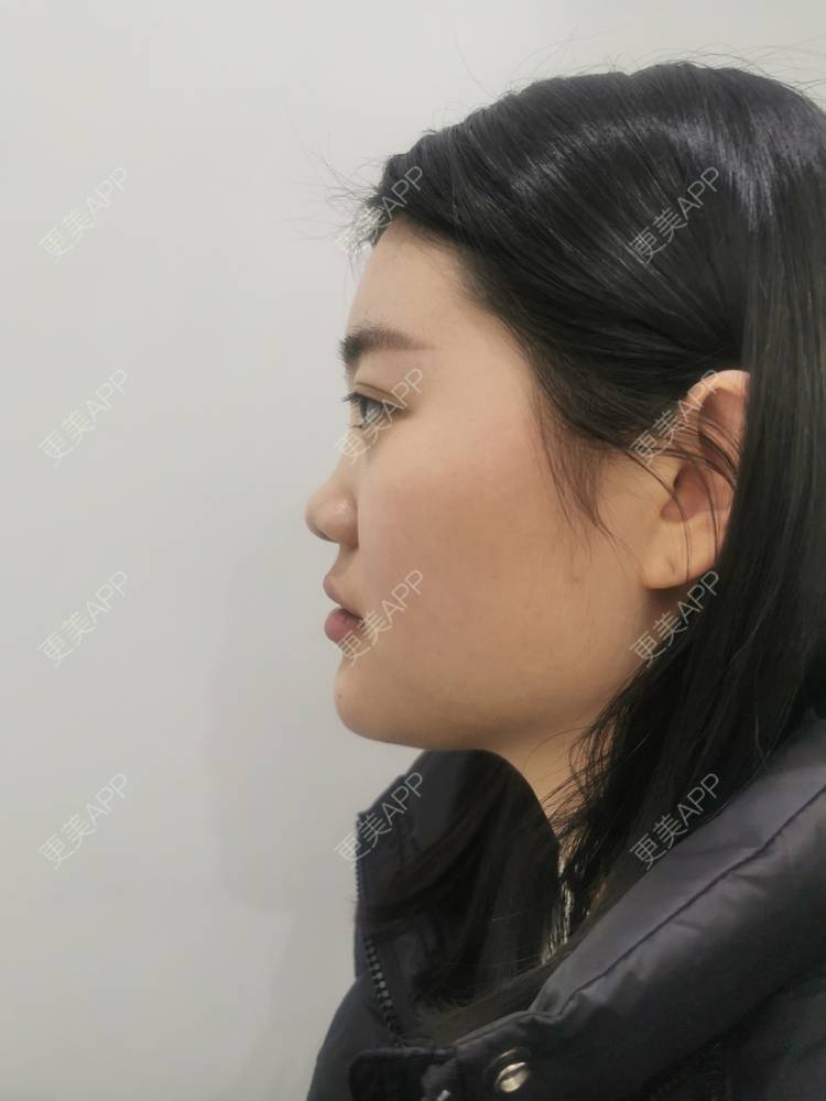 更美 - 软耳兔兔1的鼻部多项经验 | 肋软骨隆鼻 | 鼻部多项 | 重庆