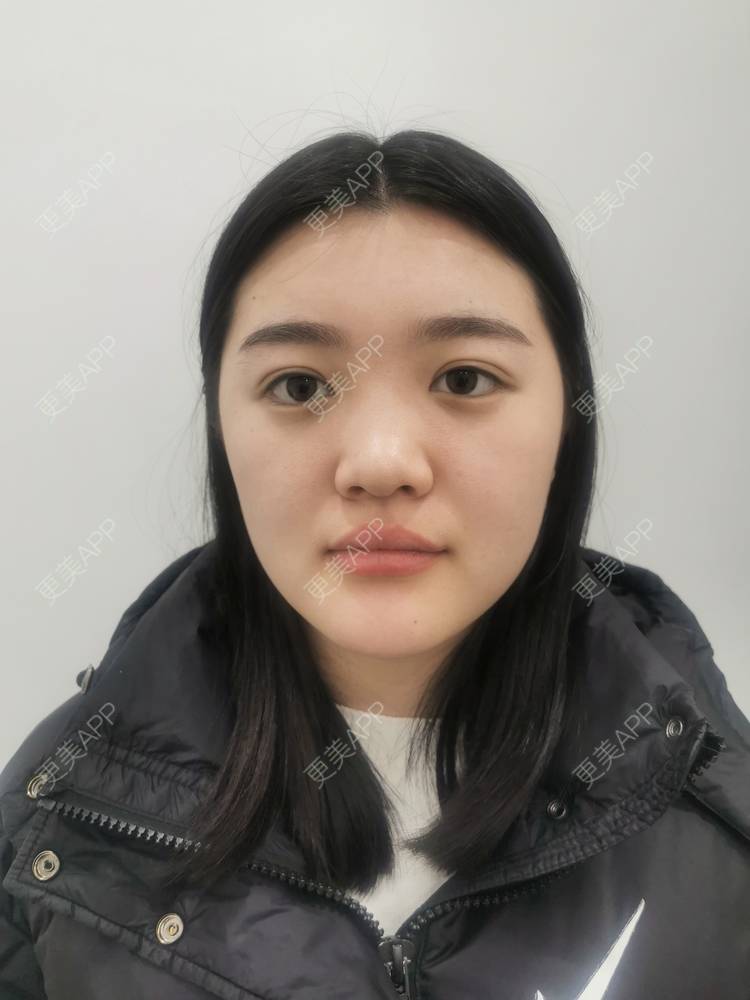 更美 - 软耳兔兔1的鼻部多项经验 | 肋软骨隆鼻 | 鼻部多项 | 重庆