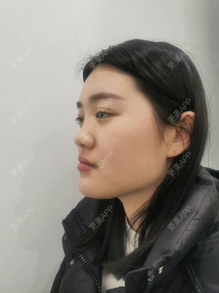更美 - 软耳兔兔1的鼻部多项经验 | 肋软骨隆鼻 | 鼻部多项 | 重庆