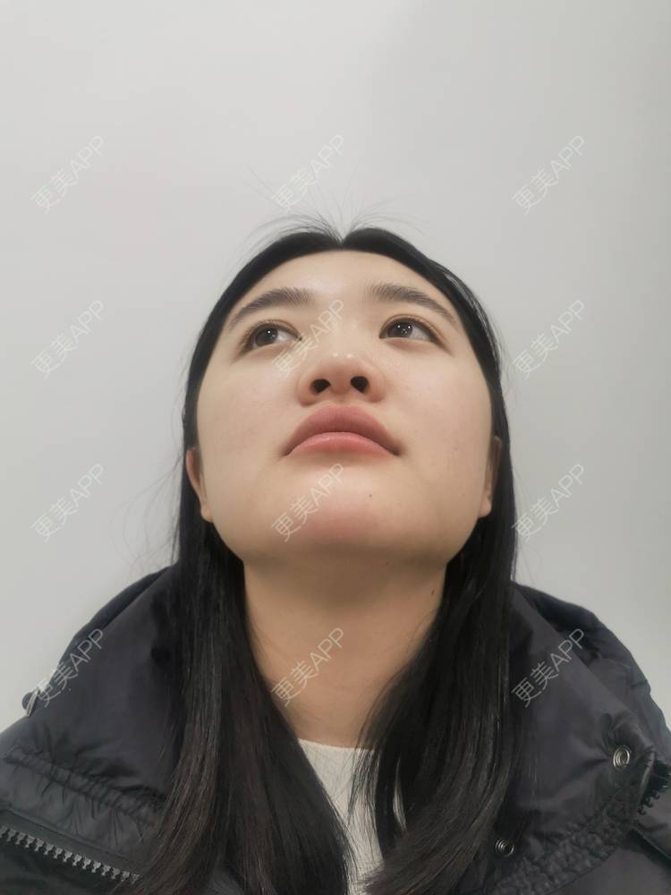更美 - 软耳兔兔1的鼻部多项经验 | 肋软骨隆鼻 | 鼻部多项 | 重庆