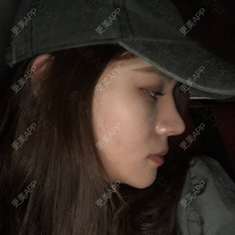 更美 - 雯晓晓的鼻部硅胶假体取出经验 | 鼻部修复 | 鼻部硅胶假体取出 | 鼻中隔软骨隆鼻