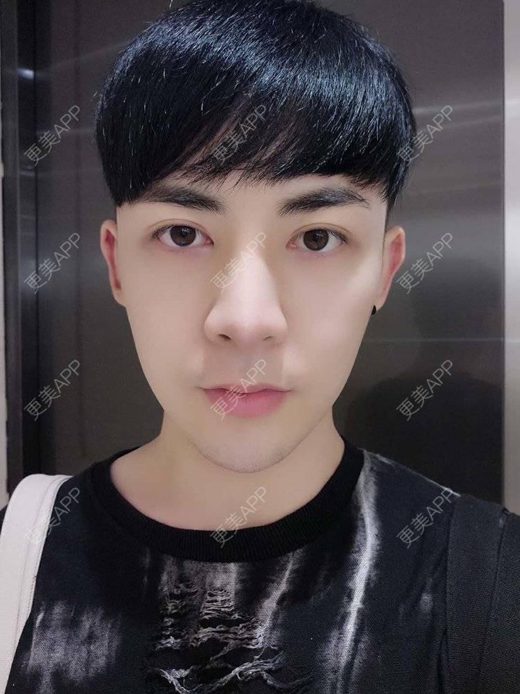 帅哥淇叔的鼻综合日记