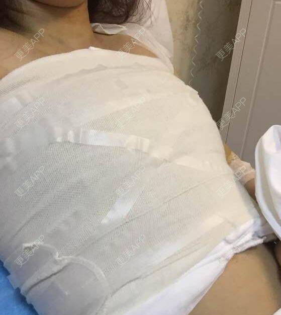 更美 - 美美你的的假体隆胸经验 | 假体隆胸 | 南京