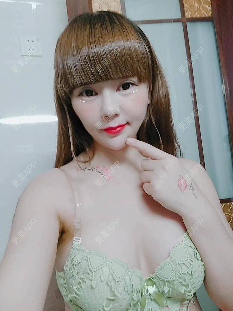 更美 - 更美用户CQ7WrXWLlK的乳房再造经验 | 乳房再造 | 假体隆胸 | 美胸套餐 | 重庆