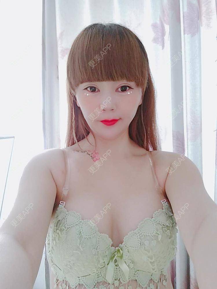 更美 - 更美用户CQ7WrXWLlK的乳房再造经验 | 乳房再造 | 假体隆胸 | 美胸套餐 | 重庆