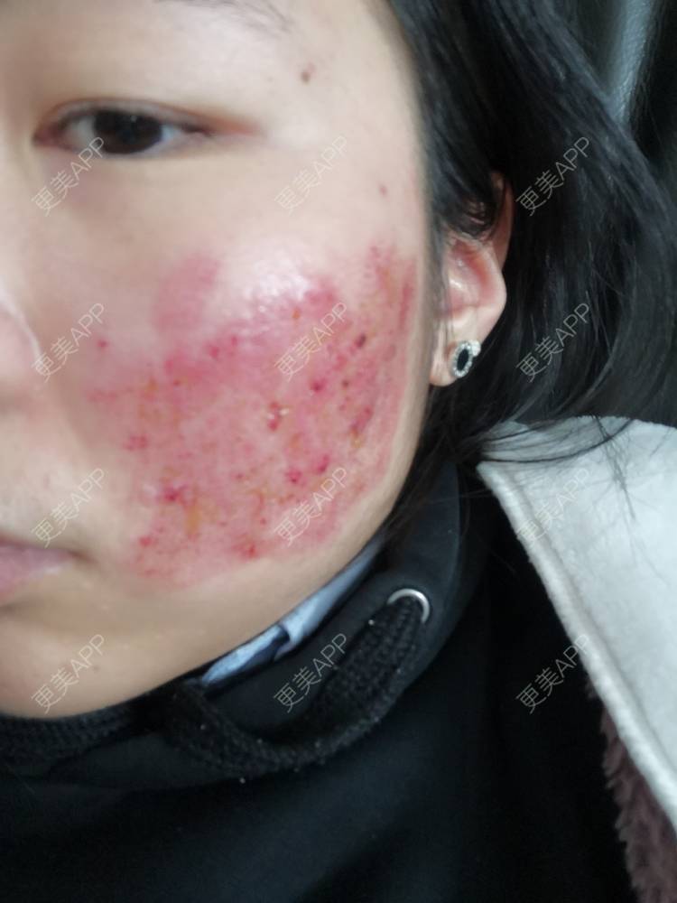 更美用户wt8hqezm9m的激光淡疤日记