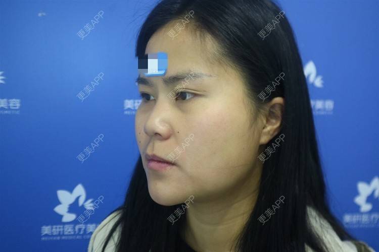 更美 - 更美用户zwQN5e8jIh的鼻部多项经验 | 鼻部多项 | 长沙