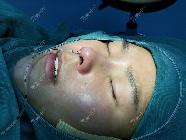 更美 - 更美用户zwQN5e8jIh的鼻部多项经验 | 鼻部多项 | 长沙