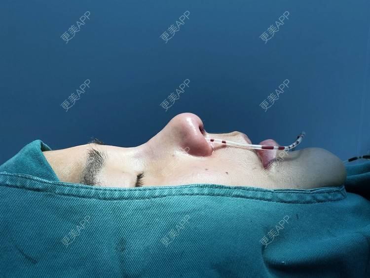 更美 - 更美用户zwQN5e8jIh的鼻部多项经验 | 鼻部多项 | 长沙