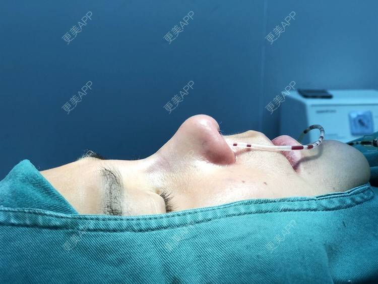 更美 - 更美用户zwQN5e8jIh的鼻部多项经验 | 鼻部多项 | 长沙