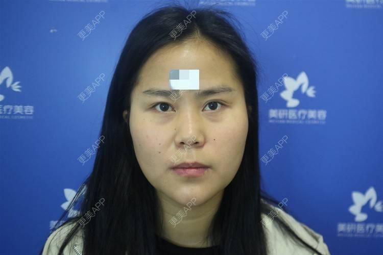 更美 - 更美用户zwQN5e8jIh的鼻部多项经验 | 鼻部多项 | 长沙