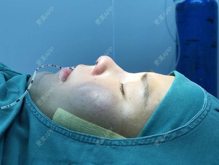 更美 - 更美用户zwQN5e8jIh的鼻部多项经验 | 鼻部多项 | 长沙