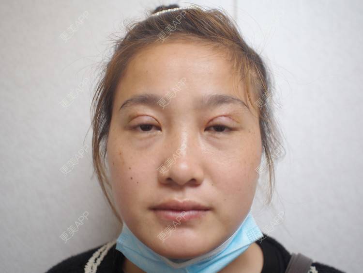 更美 - 蠻獲潑哋あ駭籽济的全切双眼皮经验 | 全切双眼皮 | 北京 | 上眼睑去脂 | 眼部多项