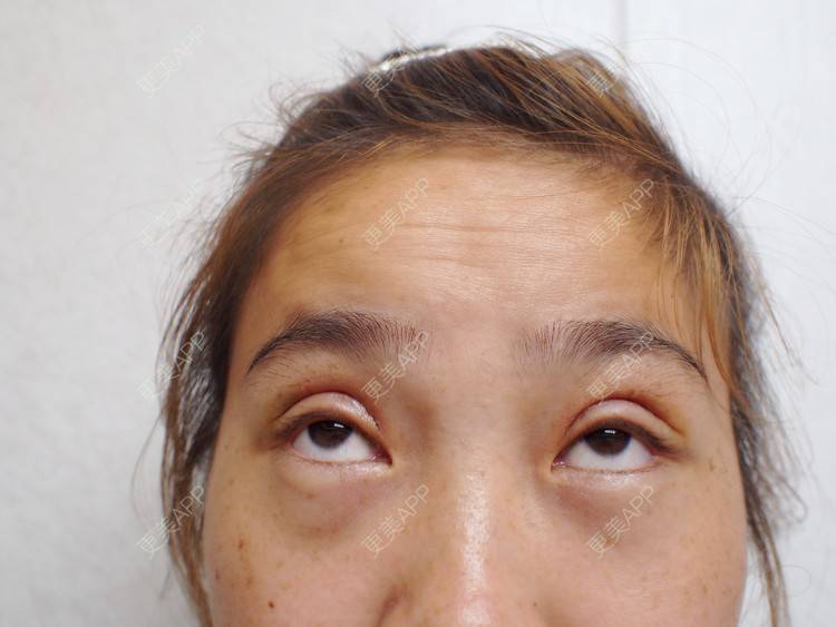 更美 - 蠻獲潑哋あ駭籽济的全切双眼皮经验 | 全切双眼皮 | 北京 | 上眼睑去脂 | 眼部多项