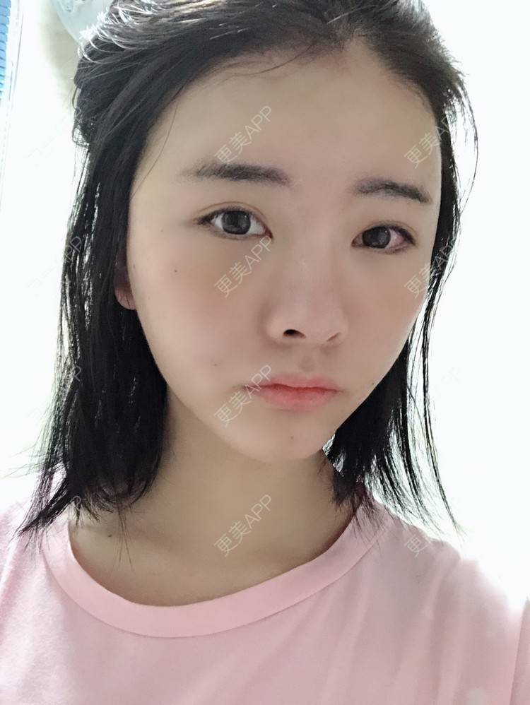 更美 - 突然想结婚了的自体脂肪丰卧蚕经验 | 自体脂肪丰太阳穴 | 自体脂肪丰卧蚕 | 视频日记 | 自体脂肪丰额头 | 赣州