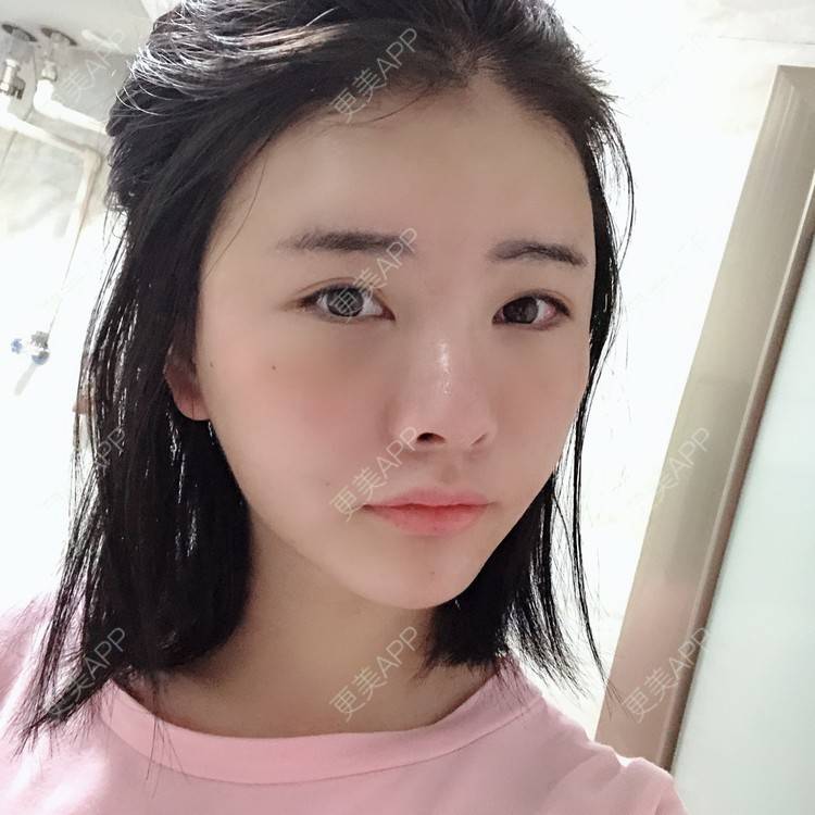 更美 - 突然想结婚了的自体脂肪丰卧蚕经验 | 自体脂肪丰太阳穴 | 自体脂肪丰卧蚕 | 视频日记 | 自体脂肪丰额头 | 赣州