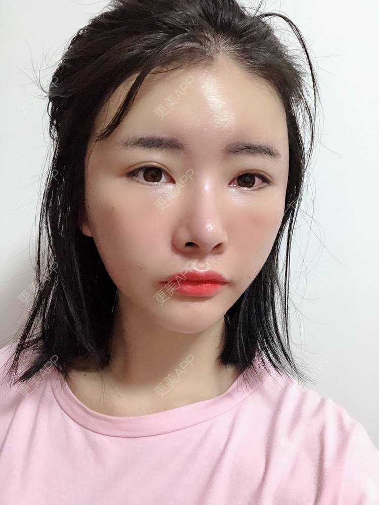 更美 - 突然想结婚了的自体脂肪丰卧蚕经验 | 自体脂肪丰太阳穴 | 自体脂肪丰卧蚕 | 视频日记 | 自体脂肪丰额头 | 赣州