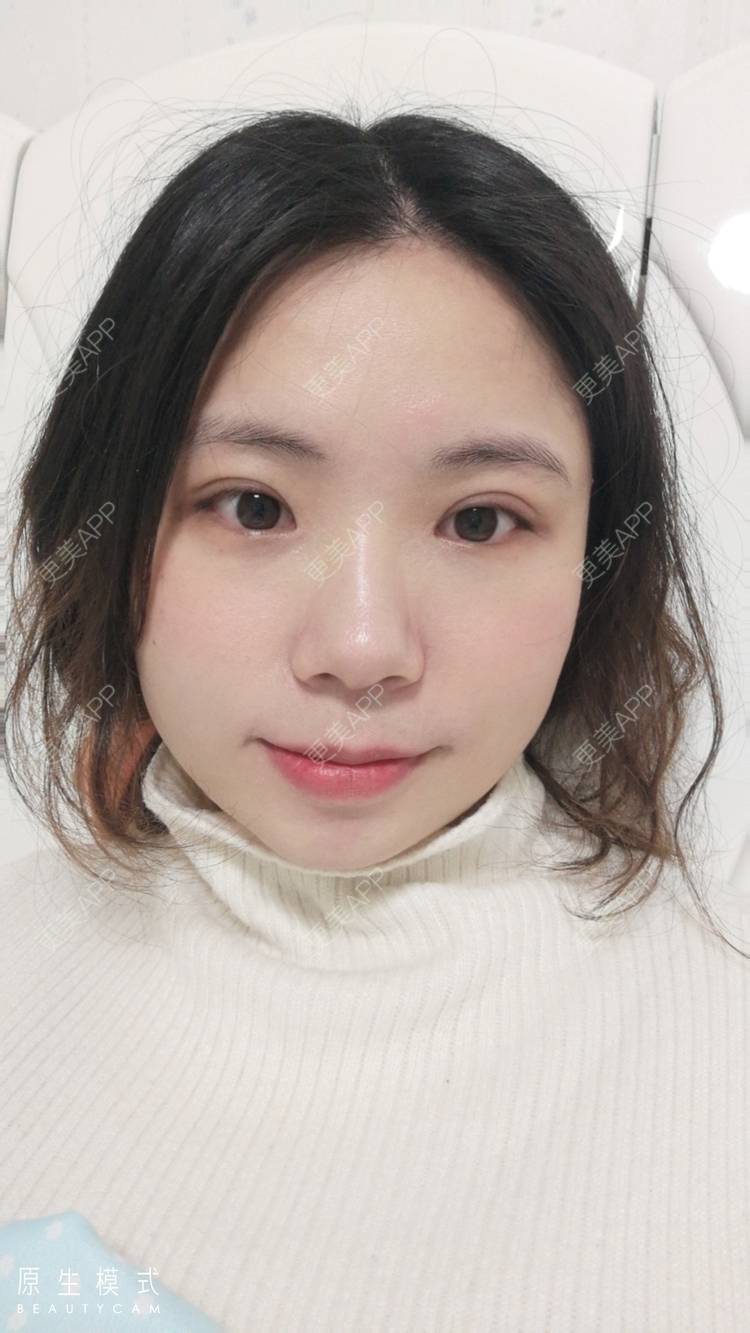 更美 - 墨七轩的双眼皮经验 | 双眼皮 | 全切双眼皮 | 开内眼角 | 开外眼角 | 杭州