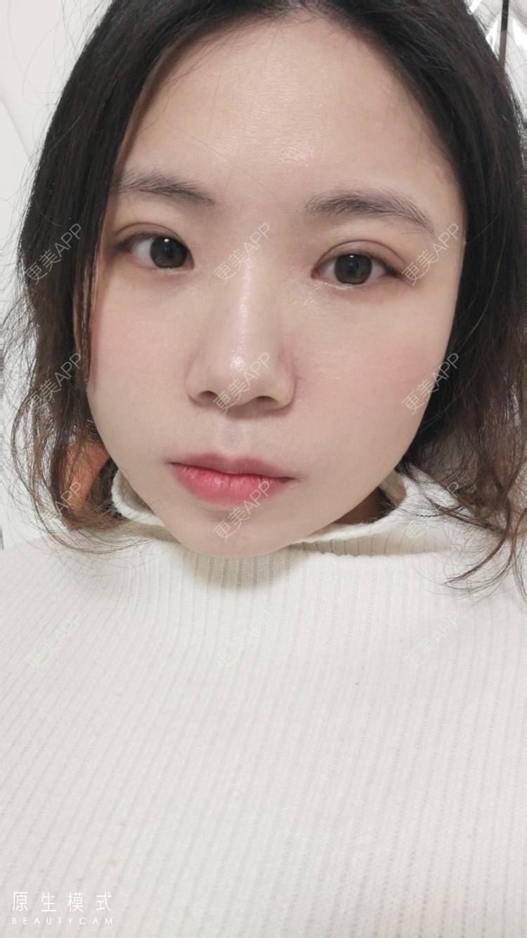 更美 - 墨七轩的双眼皮经验 | 双眼皮 | 全切双眼皮 | 开内眼角 | 开外眼角 | 杭州