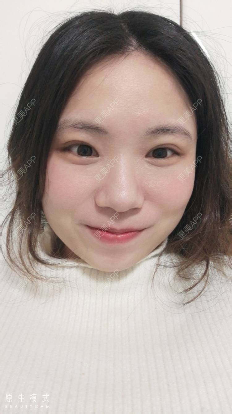 更美 - 墨七轩的双眼皮经验 | 双眼皮 | 全切双眼皮 | 开内眼角 | 开外眼角 | 杭州