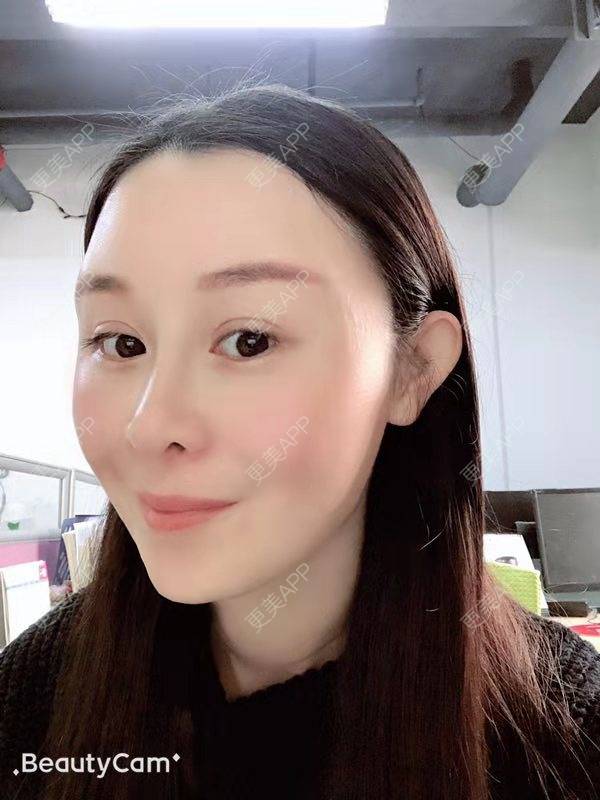 更美 - 冬天的第一场雪的玻尿酸太阳穴经验 | 玻尿酸太阳穴 | 沈阳