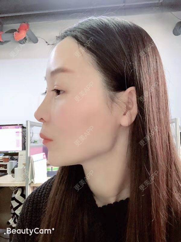 更美 - 冬天的第一场雪的玻尿酸太阳穴经验 | 玻尿酸太阳穴 | 沈阳