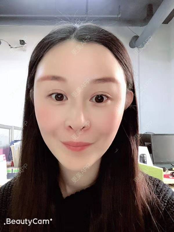 更美 - 冬天的第一场雪的玻尿酸太阳穴经验 | 玻尿酸太阳穴 | 沈阳