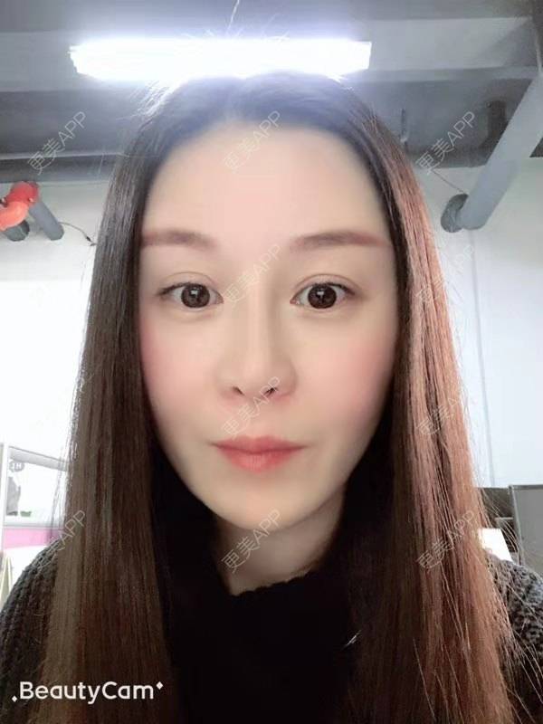 更美 - 冬天的第一场雪的玻尿酸太阳穴经验 | 玻尿酸太阳穴 | 沈阳
