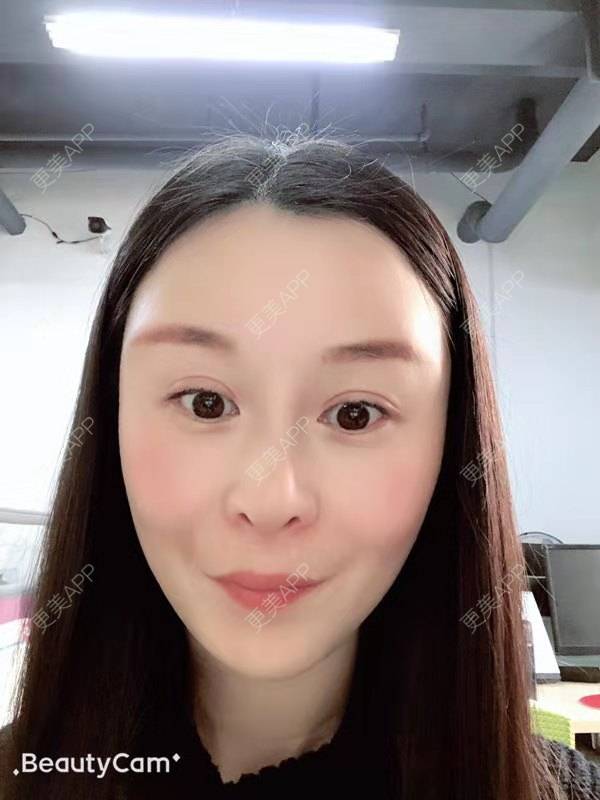 更美 - 冬天的第一场雪的玻尿酸太阳穴经验 | 玻尿酸太阳穴 | 沈阳