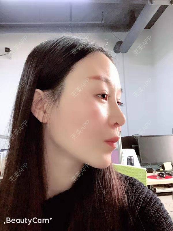 更美 - 冬天的第一场雪的玻尿酸太阳穴经验 | 玻尿酸太阳穴 | 沈阳