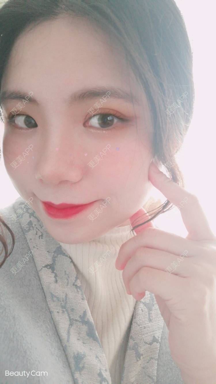 更美 - 墨七轩的双眼皮经验 | 双眼皮 | 全切双眼皮 | 开内眼角 | 开外眼角 | 杭州