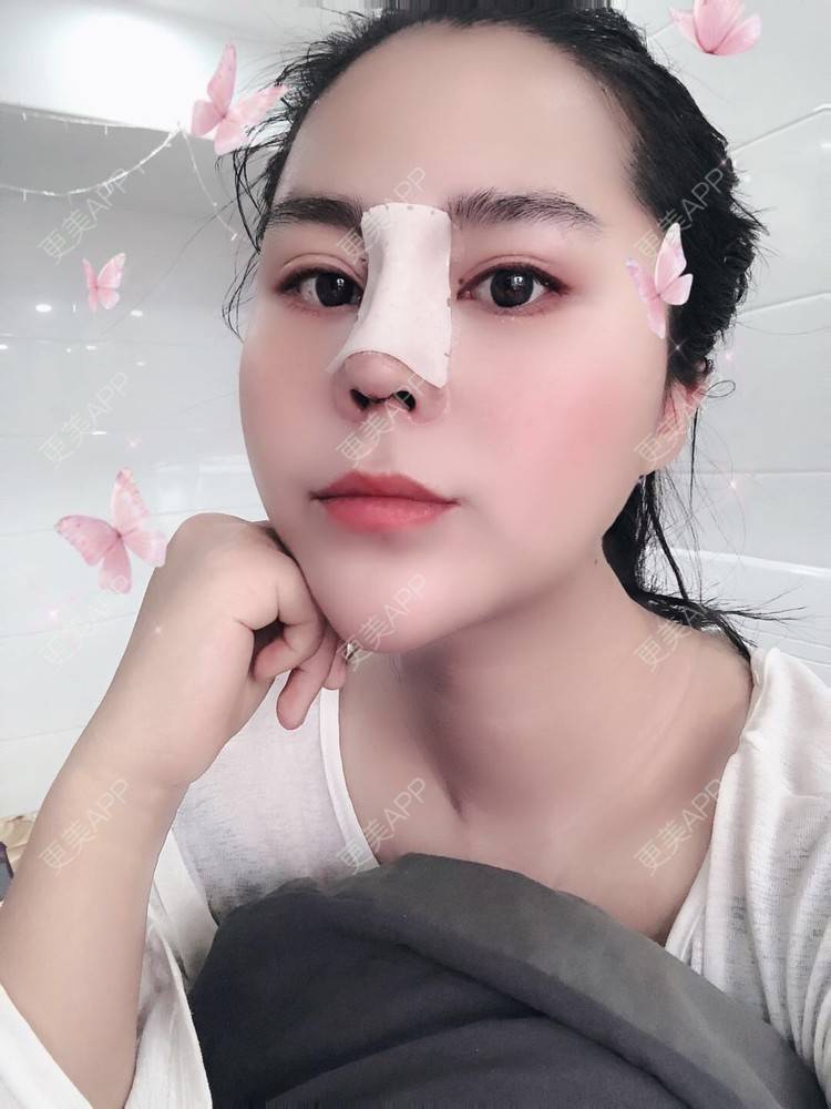 更美 - 更美用户zwQN5e8jIh的鼻部多项经验 | 鼻部多项 | 长沙