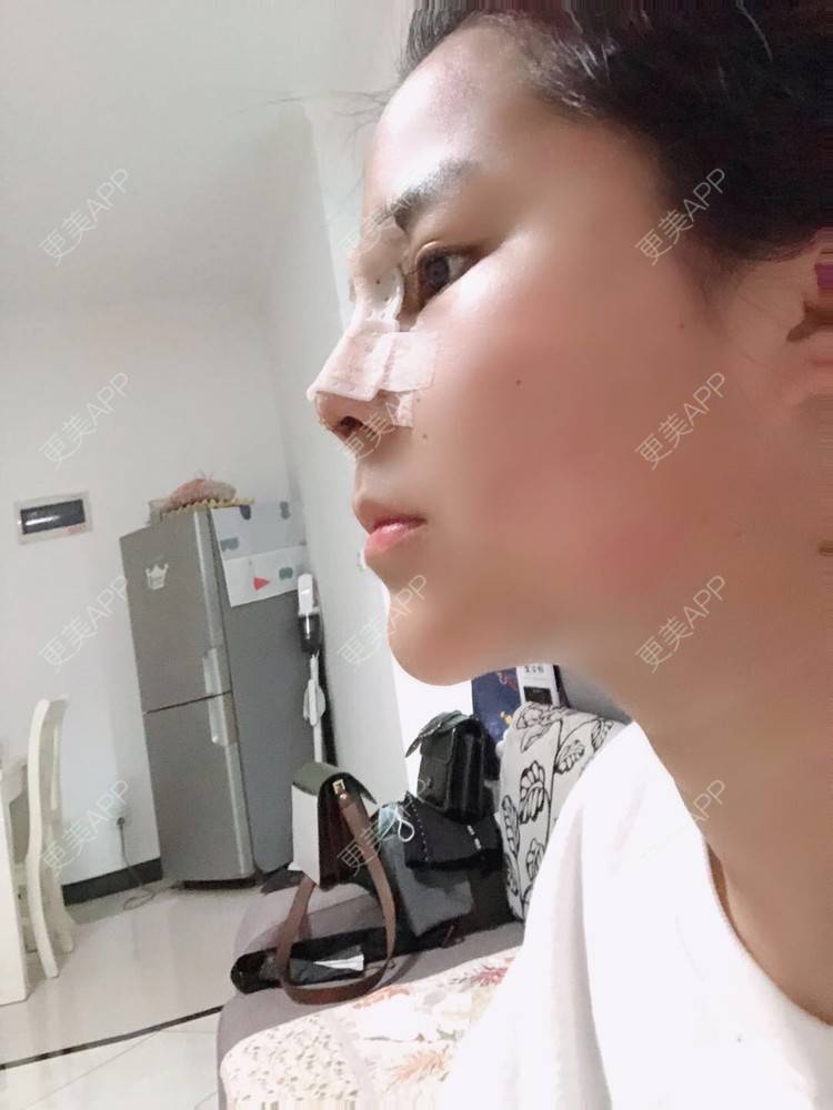 更美 - 更美用户zwQN5e8jIh的鼻部多项经验 | 鼻部多项 | 长沙