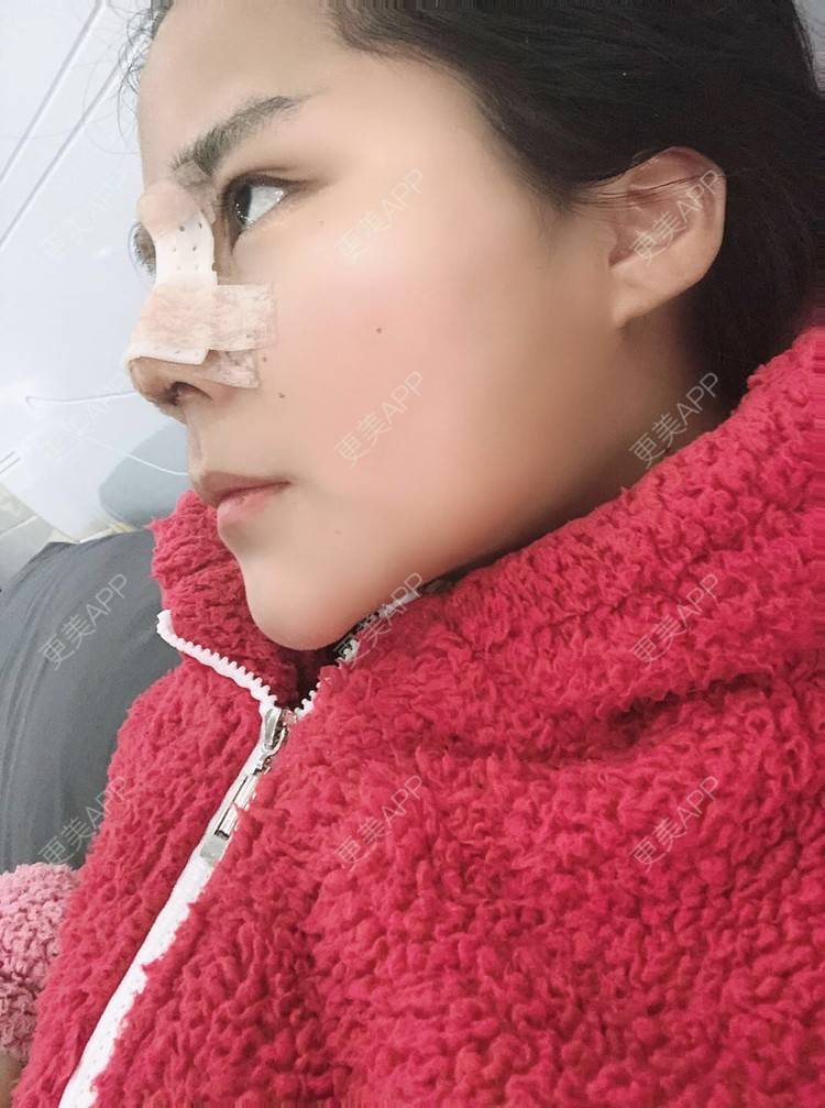 更美 - 更美用户zwQN5e8jIh的鼻部多项经验 | 鼻部多项 | 长沙