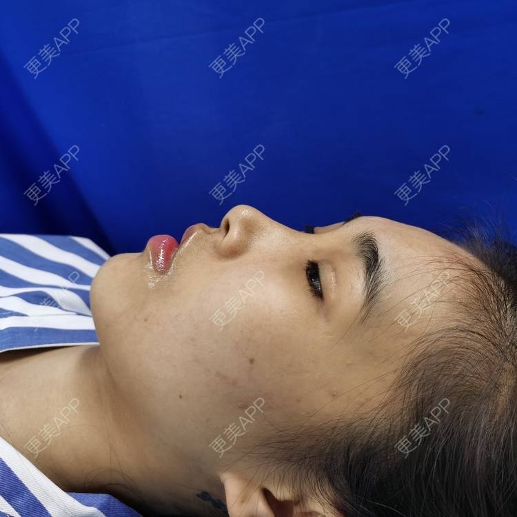 更美 - 更美用户xYVdPVYfsV的鼻部多项经验 | 鼻部多项 | 郑州