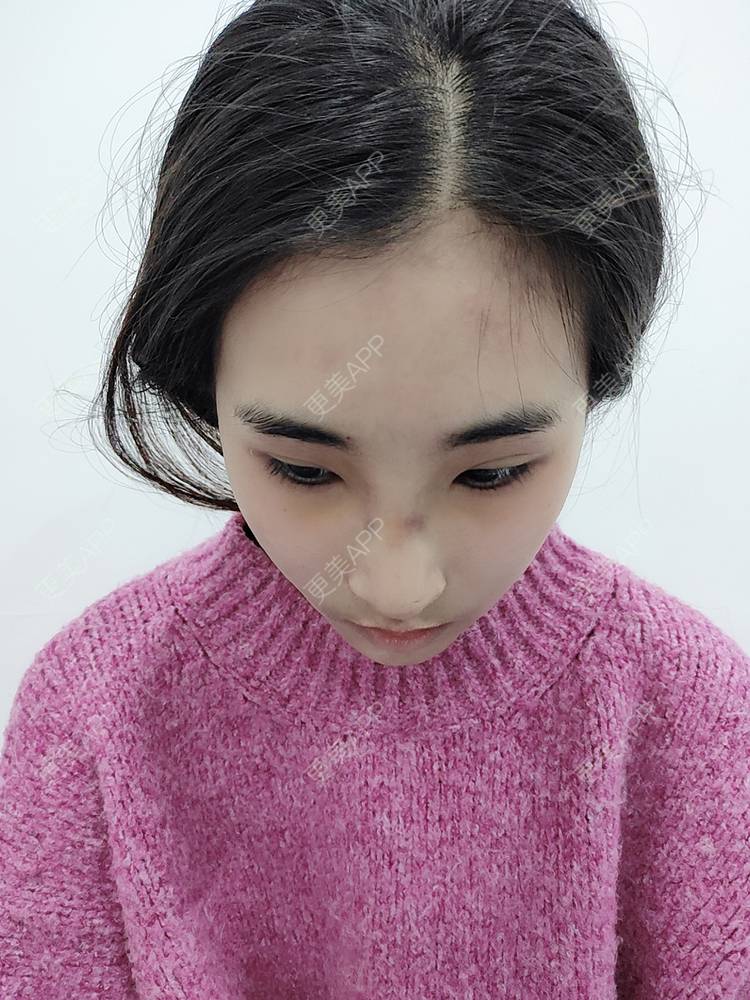 更美 - 更美用户xYVdPVYfsV的鼻部多项经验 | 鼻部多项 | 郑州