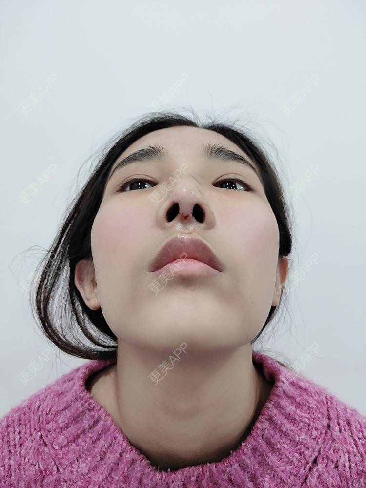 更美 - 更美用户xYVdPVYfsV的鼻部多项经验 | 鼻部多项 | 郑州